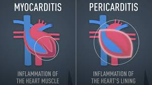 It's an inflammation of the heart muscle, usually caused by a virus. Can Covid 19 Damage The Heart Even In Asymptomatic Patients Cgtn