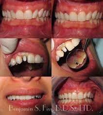 Dental Implants Chicago Benjamin S Fiss D D S
