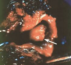 Image result for Broncholithiasis