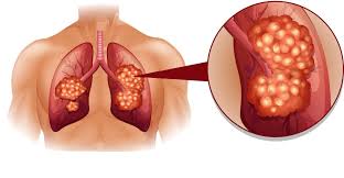Image result for Stage 4 Lung Cancer Life Expectancy stage and Survivors