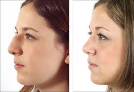 Take The Next Step Request A Free Consultation For A Nose Reshaping Or Problems Breathing Through Your Nose Now And Rhinoplasty Nose Jobs Nose Job Rhinoplasty
