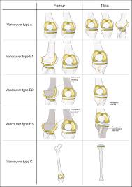 Image result for Fracture Types