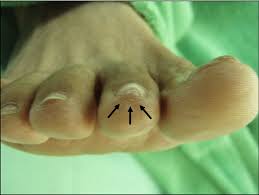 Image result for Glomus tumor