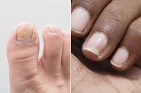 Image result for Pitting nails feet
