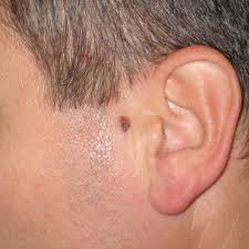 A cancer diagnosis can leave you unable to comprehend anything else your doctor says, but it's important to pay attention to what stage of cancer you have. Melanoma Ors Plastic Surgery