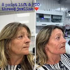 Ace Beauty Clinic Advanced Aesthetics 2, Wood street Arnold Nottingham NG5  7DY. Turning back time with the 8 point lift using filler ❤️ Dm me to book  or head over to my