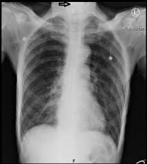 Swelling or lumps in the neck. Laryngeal Carcinoma Presented With Thyroid Mass Symptoms The Importance Of Early Onset Hoarseness And Absent Of Laryngeal Crepitus Sciencedirect
