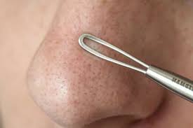 Existem várias formas naturais e caseiras de remover cravos do rosto como fazer uma máscara com gelatina e leite ou utilizar um esfoliante de aveia ou açúcar, por exemplo. O Que Sao Cravos Tipos Causas E Como Tirar Do Nariz E Do Rosto Badalo