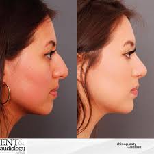 Rhinoplasty London