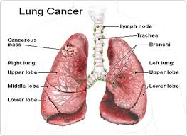 Still, it's important to be. Lung Cancer Symptoms Modern Cancer Hospital Guangzhou China