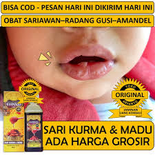 Maybe you would like to learn more about one of these? Jual Produk Obat Sariawan Amandel Termurah Dan Terlengkap Agustus 2021 Bukalapak