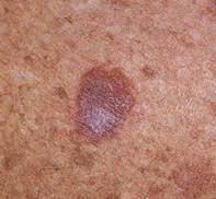 Image result for Solar Lentigo