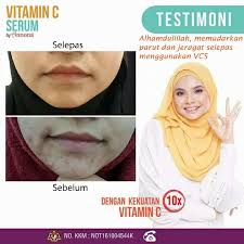 Agar anda semakin yakin bahwa vitamin c bukan sekedar nutrisi bisa, berikut beberapa menfaat yang ada di dalam vitamin c. Cantik Tak Perlu Suntik Dengan Vitamin C Serum Annona Real Life