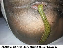 External hemorrhoids are asymptomatic except when secondary thrombosis occurs. Role Of Jaloukavacharan In Thrombosed Hemorrhoids A Case Study Semantic Scholar