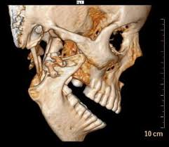 Jay robinson is the backbone of 4marketing perry padina is the backbone of fcc paragon. Analysis For Different Functional Results Of Tmj Ankylosis Management By Comparing Ramus Condyle Unit Reconstruction Using Vertical Ramus Osteotomy And Interpositional Gap Arthroplasty Oral Surgery Oral Medicine Oral Pathology And Oral Radiology