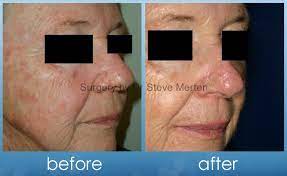 This is called topical chemotherapy. Skin Cancer Surgery Treatment Sydney