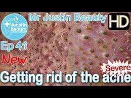 This Video May Contain Dermatologic Surgical And Or Procedural Content The Content Seen In This Video Is Forehead Acne Pimples Under The Skin Pimples On Chin