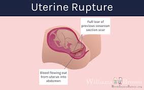 Uterine Rupture Birth Injury Safety