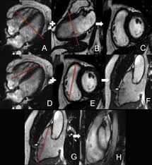 The possible pathophysiology and proposed guideline. Mr Imaging Of Arrhythmogenic Right Ventricular Dysplasia What The Radiologist Needs To Know Sciencedirect