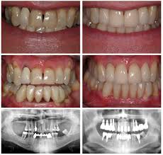 Brush your teeth for about 2 minutes last thing at night before you go to bed and on 1 other occasion every day. How Long Does A Dental Bridge Last Advanced Dentistry