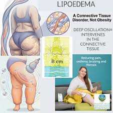 Image result for Connective Tissue Disorder