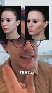 Linha de Dennie-Morgan: aquela “olheira” que não é o que parece! Se você já  notou uma linha ou sulco bem marcado logo abaixo dos olhos, pode estar  lidando com a famosa Linha