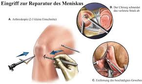 Innenmeniskusverletzungen (also des meniscus medialis) sind wesentlich häufiger als die des außenmeniskus (meniscus lateralis). Meniskusriss Im Knie Schmerzen Symptome Operation Anriss