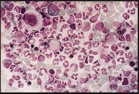 La llc est une prolifération lymphoïde monoclonale, responsable d'une infiltration médullaire, sanguine et la moitié resteront au stade a et auront une espérance de vie normale, l'autre moitié évoluera vers. Leucemie Chronique Quels Traitements Reponses Bien Vieillir Fr