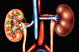 The kidneys are located under the rib cage in your lower back. Where Stones Can Form In Your Body