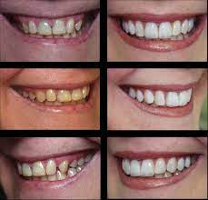 See full list on thedentalguide.net The Effect Of Veneers On Cosmetic Improvement British Dental Journal