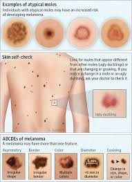 Atypical Moles Different Types Diagram Dermatology Nurse