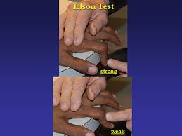 Image result for Elson Extensor Tendon Test