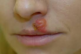 After your chickenpox are gone, the varicella virus stays in your body as an inactive virus. Superinfizierten Herpes Effektiv Behandeln Derma Plus