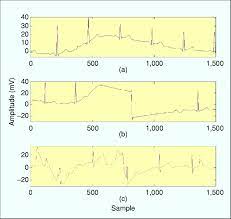 Bügeleinlagen und vlieseline zum säumen & verstärken jetzt bestellen. Standard Ecg Features A Wandering Baseline B Motion Artifact And Download Scientific Diagram