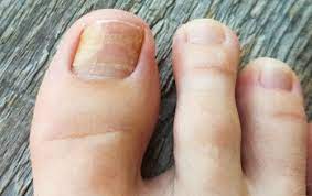 Para tratar este tipo de hongo el primer paso es usar una crema a base de ácido nítrico o ácido tricloraocético. Hongos En Las Unas De Los Pies U Onicomicosis 10 Remedios