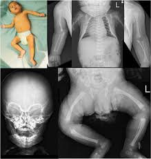 Image result for Craniotabes