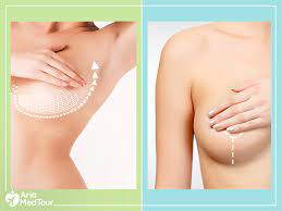 Recovery from treatment will resemble your recovery from the initial breast implant surgery. Breast Implants Vs Breast Lift The Differences And Similarities