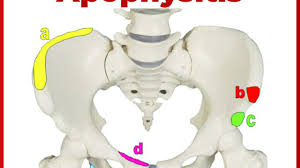 Image result for Pubic Apophysitis