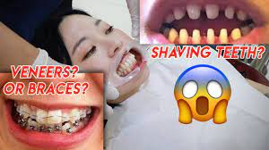 Best of all, our webcam chat site allows you to watch private shows for free. Veneers Vs Braces Read This First 2021