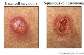 An estimated 9,500 americans receive a skin cancer diagnosis each day. Excision Of Non Melanoma Skin Cancer Care Instructions