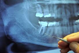 Avez Vous Une Maladie Degenerative Chronique Si Oui Avez Vous Ete Informe Que C Est Juste Dans Votre Dental Procedures Degenerative Disease Cancer Patients