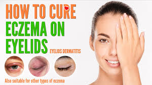 How long does eyelid dermatitis last? How To Cure Eczema On Eyelids Eyelids Dermatitis Treatment And Natural Home Remedies 2021 Youtube