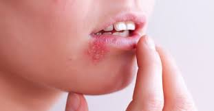 Vesicles may also develop on the lips and skin around the mouth (herpetic dermatitis), and cervical lymphadenopathy can occur. Here S What You Need To Know About Cold Sores And Herpes