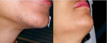 While minor side effects such as redness. Laser Hair Removal Before And After Manchester Clear Medical
