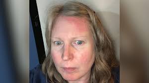 Lupus: The women 'constantly fatigued' by chronic condition made worse by  'poor support' in Wales