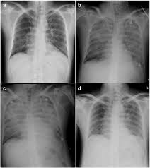 Important to diagnose due to public health concern. Acute Respiratory Distress Syndrome And Acute Myocarditis Developed In A Previously Healthy Adult With Influenza B Springerlink