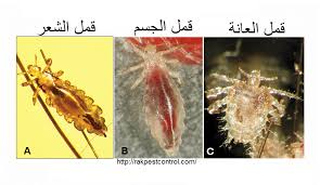 القمل التخلص من القمل الصيبان حشرات الرأس الحشرات رأس الخيمة
