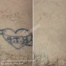 We explain how long tattoo removal healing takes and what to expect after laser tattoo removal, so you can go in fully informed. Laser Tattoo Removal Specialists In Sydney Cosmedix Clinics