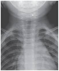 Image result for Croup