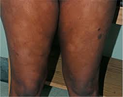 Image result for Postinflammatory Hypopigmentation